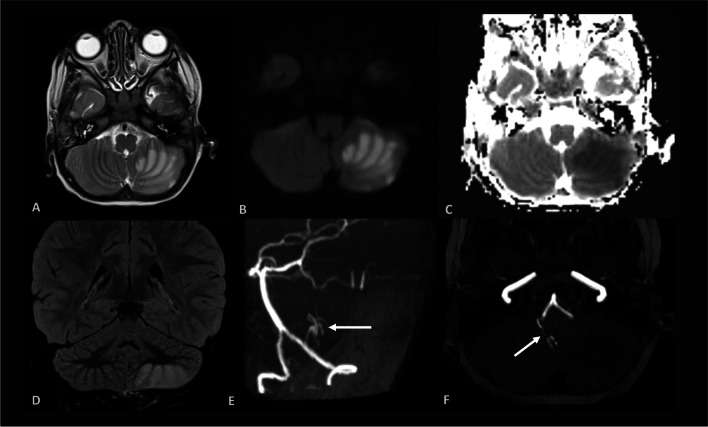 Isolated cerebellar stroke in a paediatric patient with typical ...