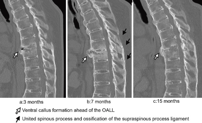 A Case of Vertebral Fracture Associated with Diffuse Idiopathic ...