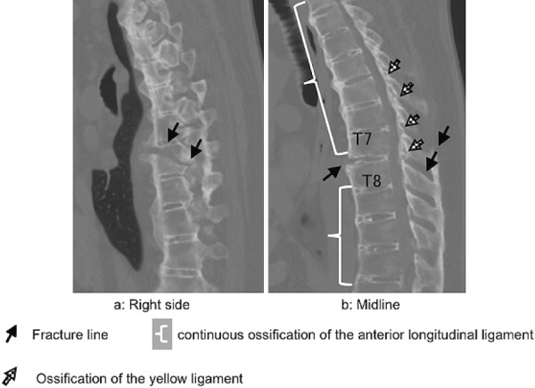 A Case of Vertebral Fracture Associated with Diffuse Idiopathic ...