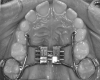 Figure 1. Rapid maxillary expansion (RME) appliance.