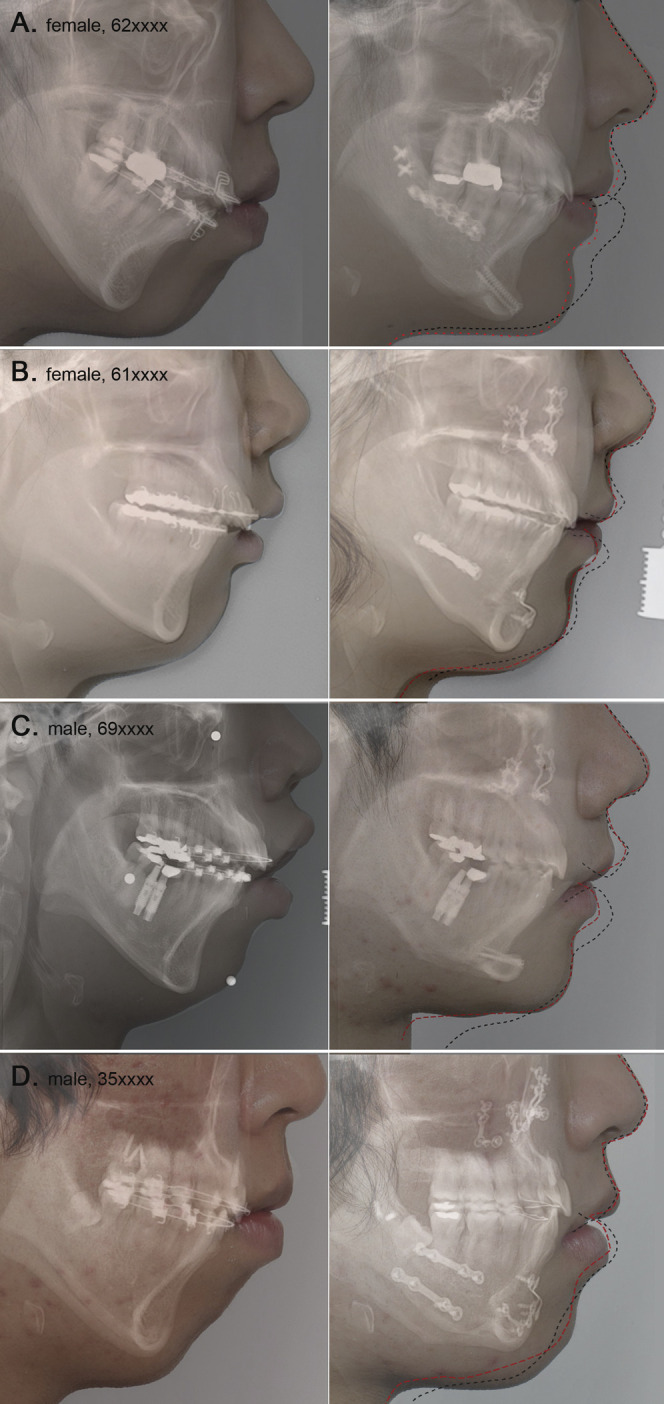 Figure 1. A graphic comparison of real cases showing original profiles on the left-hand side and actual postoperative profiles on the right-hand side. In this study, accuracy of the actual resulting soft tissue response is considered to be the measure of prediction quality. Black dashed lines indicate the profile predicted using commercial software that applies a conventional prediction algorithm. Red dotted lines superimpose the predicted profile produced by our prediction method. Although discrepancies between predictions and actual treatment outcomes were evident, the results using our method had a better prediction quality. The red lines seem to have a more natural curvature and a more accurate prediction than the black lines that were produced by the commercial software. In cases of preoperative strained lower lip, lip incompetency, and adjunctive genioplasty, our method showed a significant improvement over the conventional method.