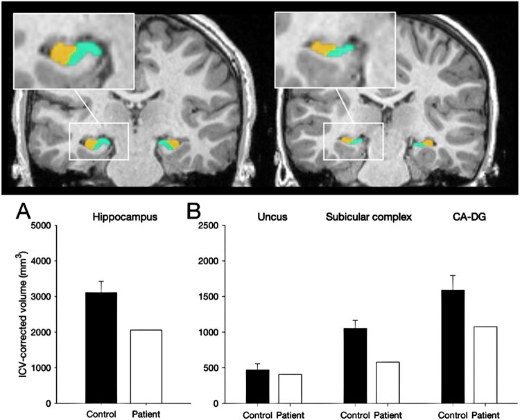 Top: A coronal section of a T1-weighted MRI scan. Manual segmentation of hippocampal subregions highlights reduced volumes in the patient compared to a control. Below Left: Hippocampal volume of a control participant is plotted beside the volume from the patient. Below Right, ICV-corrected volumes of hippocampal subregions are plotted to show reduced volumes in the patient compared to controls.