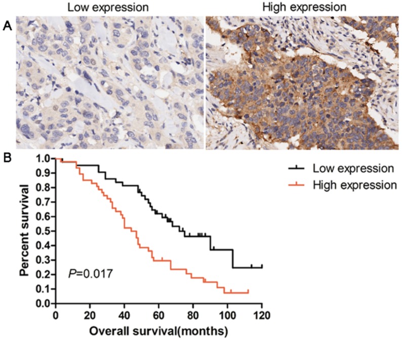 Eosinophil Peroxidase Over-expression Predicts The Clinical Outcome Of 