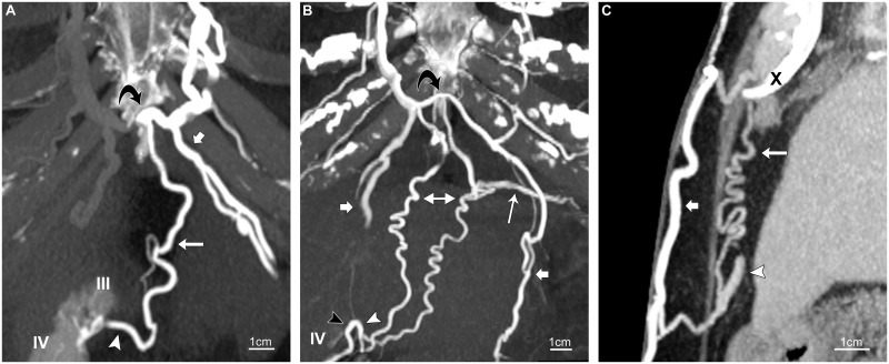 CT of the paraumbilical and ensiform veins in patients with superior ...