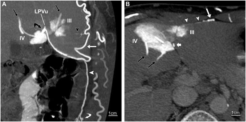 CT of the paraumbilical and ensiform veins in patients with superior ...