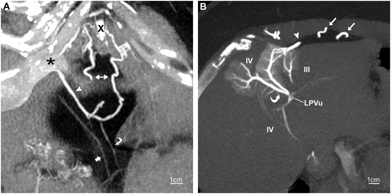 CT of the paraumbilical and ensiform veins in patients with superior ...