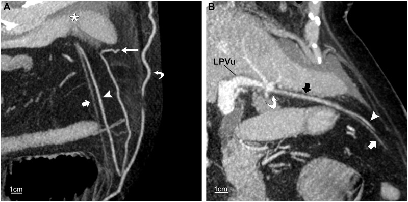 CT of the paraumbilical and ensiform veins in patients with superior ...