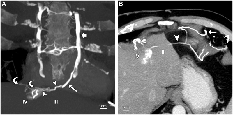 CT of the paraumbilical and ensiform veins in patients with superior ...