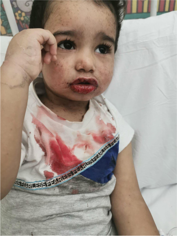 Extensive eczema herpeticum in a previously well child pmc