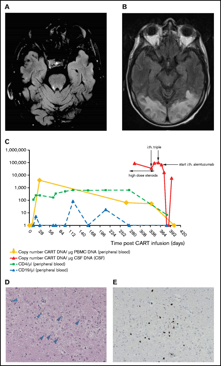 Fatal late-onset CAR T-cell–mediated encephalitis after axicabtagene ...