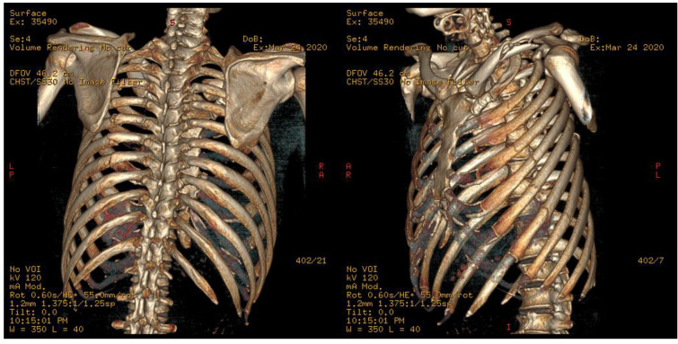 K-Rod: An Innovative Method of Personalized Rib Splinting for ...