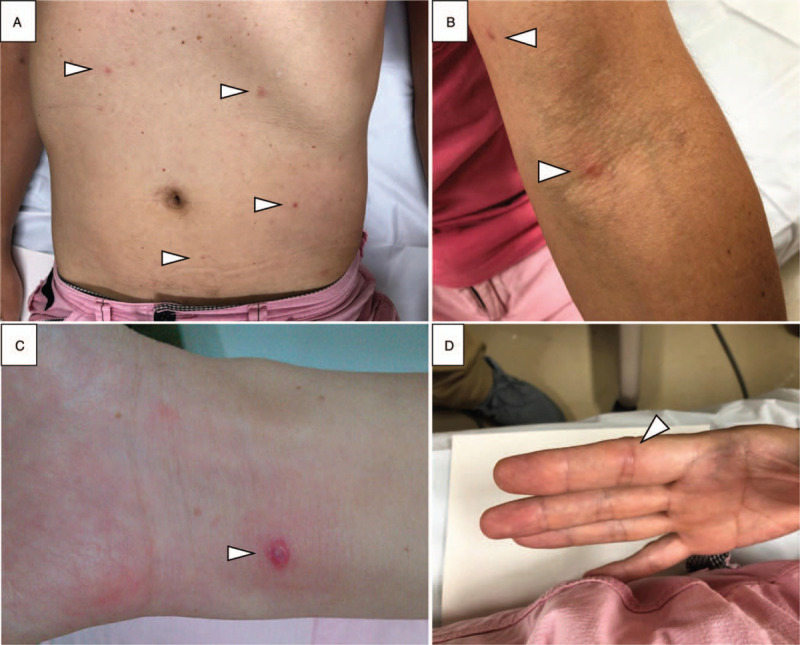 Disseminated gonococcal infection in a Japanese man with complement 7 ...