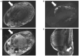 Figure 1. Magnetic resonance imaging. (A) T2–weighted image. A 27×20 cm mass (white arrowhead) with heterogeneous high and low signal areas in the uterus. (B) Diffusion–weighted image. The solid part ...