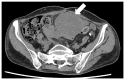 Figure 5. Computed tomography scan performed 1 month after surgery. The largest of the three new solid tumors that had recurred in the abdominal cavity (maximum diameter 7 cm) (white arrowhead).