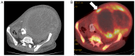 Figure 2. Radiological findings. (A) Computed tomography scan. A heterogeneous, septate, mixed–density mass was seen in the transverse section. (B) Positron emission tomography–computed tomography. Hy...