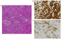 Figure 4. Pathological findings. (A) Hematoxylin and eosin stain. The atypical cells with enlarged nuclei and distinct nucleoli formed a reticular structure like a vascular cavity and exhibited signs ...