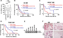 Figure 1. IL13Rα2 expression is high in BM, and increased levels predict worse survival after brain metastasis diagnoses. A, IL13Rα2 IHC staining was scored using Aperio Digital Imaging, and tumoral areas with strong intensity scores were considered positive. Graph shows percentage of positive tumor area for a cohort of BM samples from Luminal A (n = 32), HER2+ (n = 27), and TNBC (n = 26) breast cancer subtypes. Data were analyzed using ANOVA. Adjusted P value is shown. B, All BMs (n = 96) were classified as high (≥25% + tumor, blue) versus low IL13Rα2 (<25% + tumor, red), and percentage of survival following BM diagnoses was plotted. C, HER2+ BMs (n = 27) were classified as high or low IL13Rα2 as in B. D, TNBC BMs (N = 26) were classified as high or low IL13Rα2 expression as in B. Kaplan–Meier curves (B–D) were analyzed using the log-rank test. E, WB shows IL13Rα2 expression in breast cancer cells. F, The percentage of tumoral area expressing IL13Rα2 in clinical BM (F2–7, G7–1) as compared with the same tumors growing as PDXs in the mammary fat pad (MFP) of NSG mice.