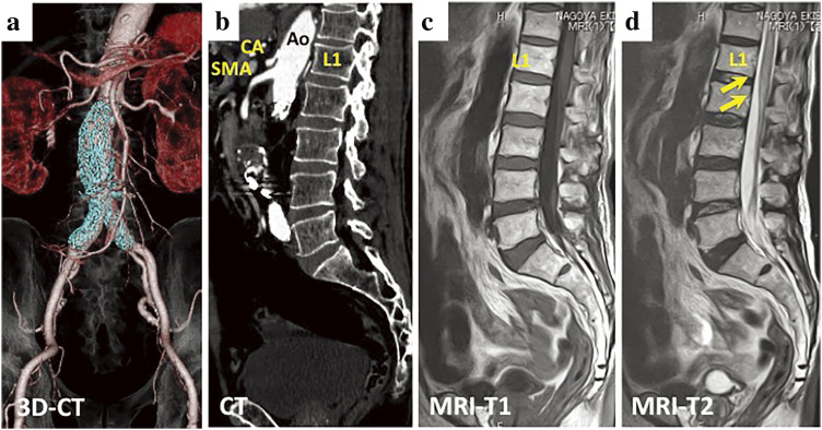 Fig. 2 Postoperative contrast-enhanced CT of the abdominal aorta (a and b) and MRI of the spinal cord (b and c). The abdominal stent graft (colored blue) is placed distal to the L2 level (a). The AKA could not be clearly identified, but the lumbar and intercostal arteries cranial to the level of the renal arteries were patent (b). Postoperative T2-weighted MRI revealed a high signal on the anterior spinal artery region of the spinal cord (d). SCI was diagnosed. AKA: artery of Adamkiewicz; SCI: spinal cord infarction; MRI: magnetic resonance imaging; CT: computed tomography; Ao: aorta; CA: celiac artery; SMA: superior mesenteric artery