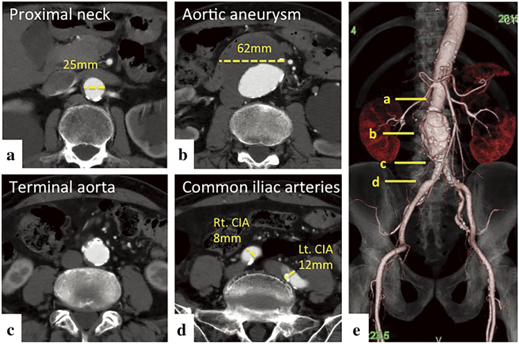 Fig. 1 Preoperative enhanced CT images. Axial images are shown in a–d. The solid lines in e indicate the corresponding positions in a–d. The proximal neck diameter of AAA is 25 mm (a). The maximum diameter of the AAA is 62 mm × 59 mm (b). The terminal aorta is not dilated (c and e). The diameter of the right CIA is 8 mm and the diameter of the left CIA is 12 mm (d). The AAA was anatomically suitable for an endovascular abdominal aortic repair device (e). AAA: abdominal aortic aneurysm; CIA: common iliac artery; CT: computed tomography