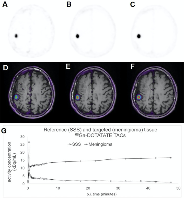 (A–C) Three axial 68Ga-DOTATATE PET dynamic images (first, fourth, and ninth 5-minute frame) in a 66-year-old woman in group A with a history of World Health Organization grade II meningioma status after resection 4 months prior to imaging and (D–F) corresponding PET T1-weighted post-gadolinium-enhancement fusion images from 5-minute frames at (A, D) 10 minutes after injection, (B, E) 30 minutes after injection, and (C, F) 45 minutes after injection. (G) Corresponding reference tissue (superior sagittal sinus [SSS]) and targeted tissue (meningioma) region time-activity curves (TACs). DOTATATE = tetraazacyclododecane tetraacetic acid octreotate, 68Ga = gallium 68, p.i. = postinjection.