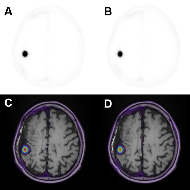 (A, B) Axial 68Ga-DOTATATE PET images and (C, D) corresponding PET T1-weighted post-gadolinium-enhancement fusion images from (A, C) the last 10-minute frame at 50–60 minutes after injection and (B, D) the entire 50-minute acquisition period at 10–60 minutes after injection in a 66-year-old woman in group A with a history of World Health Organization grade II meningioma status (same participant as in Fig 1). DOTATATE = tetraazacyclododecane tetraacetic acid octreotate, 68Ga = gallium 68.