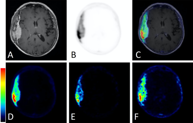 Comparison of static standardized uptake value (SUV) and standard Patlak (sPatlak)–derived parametric images in a second representative participant from group A. This 81-year-old woman presented with an avidly enhancing dural-based mass along the right temporal convexity. (A) Dural-based mass with heterogeneous enhancement of the overlying calvarium concerning for intraosseous extension as presented in T1-weighted postcontrast image alone. (B) Corresponding PET and (C) PET/MRI fusion images demonstrate intense 68Ga-DOTATATE avidity within both the dural-based and the intraosseous components of the mass. (D) Static PET image from the last 10 minutes of acquisition (50–60 minutes after injection), along with (E) Patlak slope Ki and (F) Patlak intercept Vb parametric images from the same PET/MRI examination. The color bars are to maximum SUV for C and D, from 0 to maximum Ki (0–0.4 mL of reference tissue/min/grams of targeted tissue) for E, and from 0 to maximum Vb (0–11 mL of reference tissue/grams of targeted tissue) for F. DOTATATE = tetraazacyclododecane tetraacetic acid octreotate, 68Ga = gallium 68, Ki = net binding rate constant, Vb = sum of blood volume fraction and distribution volume.