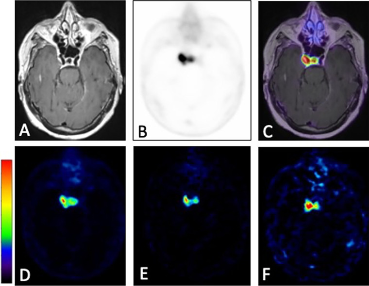 Comparison of static standardized uptake value (SUV) and standard Patlak (sPatlak)–derived parametric images in a representative examination from group A. This 72-year-old woman with a history of right cavernous sinus meningioma who underwent gamma knife radiosurgery 12 years prior presented with an avidly enhancing soft-tissue mass involving the right cavernous sinus, not well delineated on (A) T1-weighted postcontrast images alone. (B) Static PET image summed over the entire 50-minute acquisition period and (C) PET/MRI fusion image demonstrate markedly improved delineation of the tumor. (D) Static PET image from the last 10 minutes of acquisition (50–60 minutes after injection), along with (E) Patlak slope Ki and (F) Patlak intercept Vb parametric images from the same PET/MRI examination. The color bars are to maximum SUV for C and D, from 0 to maximum Ki (0–0.4 mL of reference tissue/min/grams of targeted tissue) for E, and from 0 to maximum Vb (0–11 mL of reference tissue/grams of targeted tissue) for F. Ki = net binding rate constant, Vb = sum of blood volume fraction and distribution volume.