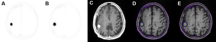 Axial images of (A) 68Ga-DOTATATE PET SUV50, (B) Patlak Ki, (C) three-dimensional T1-weighted post-gadolinium-enhanced MRI, (D) fused PET SUV/MRI T1, and (E) fused Patlak Ki/MRI T1 parameters in a 66-year-old woman in group A with a history of World Health Organization grade II meningioma status (same participant as in Fig 1). DOTATATE = tetraazacyclododecane tetraacetic acid octreotate, 68Ga = gallium 68, Ki = net binding rate constant, SUV = standardized uptake value, SUV50 = SUV extracted from the entire 50 minutes of acquisition.