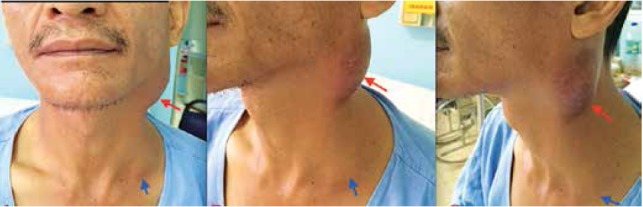 Figure 1: Level II swelling on the left side of the neck measuring 4 × 5 cm and inflammation over the skin (orange arrow). Left supraclavicular swelling measuring 4 × 4 cm with normal overlying skin (blue arrow)