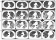 
<bold>A</bold>: Bilateral ground glass opacities are visible in the lungs on day 6 after symptom onset. <bold>B</bold>: Diffuse bilateral areas of ground-glass opacities and consolidation of the peripheries of both lungs on day 11 after symptom onset. <bold>C</bold>: Increased diffuse bilateral areas of ground glass opacities and consolidation on day 18 after symptom onset. <bold>D</bold>: Gradual resolution of consolidation and partially reticular pulmonary fibrosis on day 31 after symptom onset.
