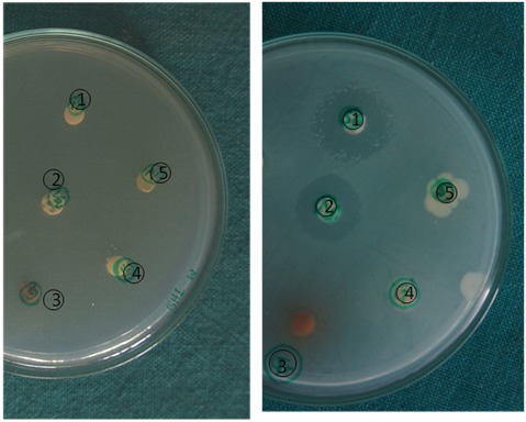 Figure: 1A and 1B: Agar disc diffusion test demonstrating the culture plates before and after completion of the diffusion test.