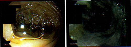 Acute esophageal necrosis: A rare case of upper gastrointestinal ...