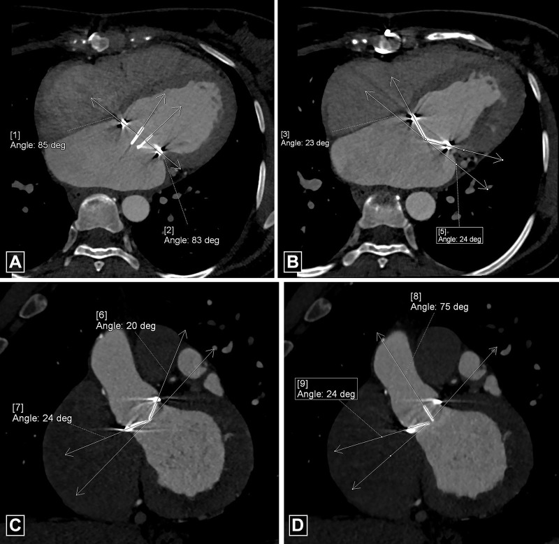 Measurements of valve mobility for bileaflet prosthetic valve. (A, B) Four-chamber images demonstrate normal opening angle (A) and closing angle (B) of the prosthetic mitral valve. By convention, at CT, opening and closing angles are defined relative to the valvular ring plane in fully open and closed positions, respectively. (C, D) Oblique coronal images demonstrate normal closing angle (C) with abnormal opening angle (D) of the stuck leaflet of the prosthetic aortic valve. deg = degrees.