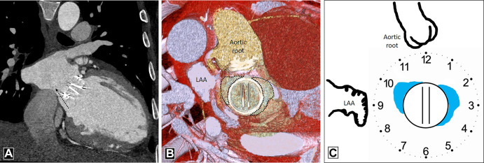 Paravalvular leak. (A) Oblique coronal image depicts paravalvular leak (dashed black arrow) adjacent to a mechanical prosthetic mitral valve. (B) Multiplanar reconstructed image and (C) schematic image depict the surgeon's perspective and reveal contrast material–filled channel (dotted outline in B and blue areas in C) adjacent to the prosthetic mitral valve at the 10-o'clock and 2- to 3-o'clock position. The patient had no prior history of infective endocarditis, so paravalvular leak was likely induced by hemodynamic changes after surgery. LAA = left atrial appendage.