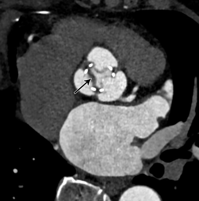 Hypoattenuating leaflet thickening several months after bioprosthetic aortic valve replacement. Oblique axial CT image demonstrates thickened and hypoattenuating leaflet (black arrow) of bioprosthetic aortic valve.