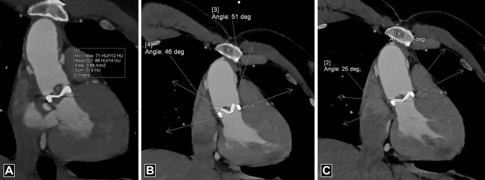 Thrombus. (A) Oblique coronal image depicts irregular hypoattenuating soft tissue with a mean CT attenuation of 86 HU predominantly on the aortic side of the prosthesis. Images in the systolic (B) and diastolic (C) phase show restricted mobility of the valve leaflets with abnormal opening angles. deg = degrees, Max = maximum, Min = minimum, SD = standard deviation.