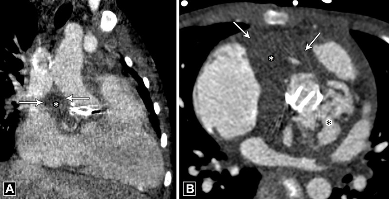 Abscess. (A) Oblique coronal and (B) axial CT images in a patient with infective endocarditis depict a collection (white asterisk) showing peripheral rim enhancement (white arrows) adjacent to a mechanical aortic valve. Note the contrast material–filled pseudoaneurysm (black asterisk in B) posterior to it.