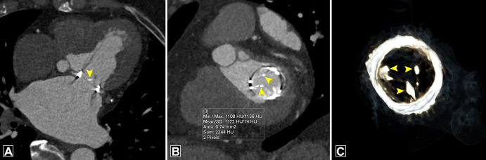 Bioprosthetic valve calcification. (A) Four-chamber image, (B) short-axis image, and (C) volume-rendered image depict calcification at the basal part of cusps (arrowheads) in a bioprosthetic mitral valve with a mean CT attenuation of 1122 HU (> 850 HU). Max = maximum, Min = minimum, SD = standard deviation.