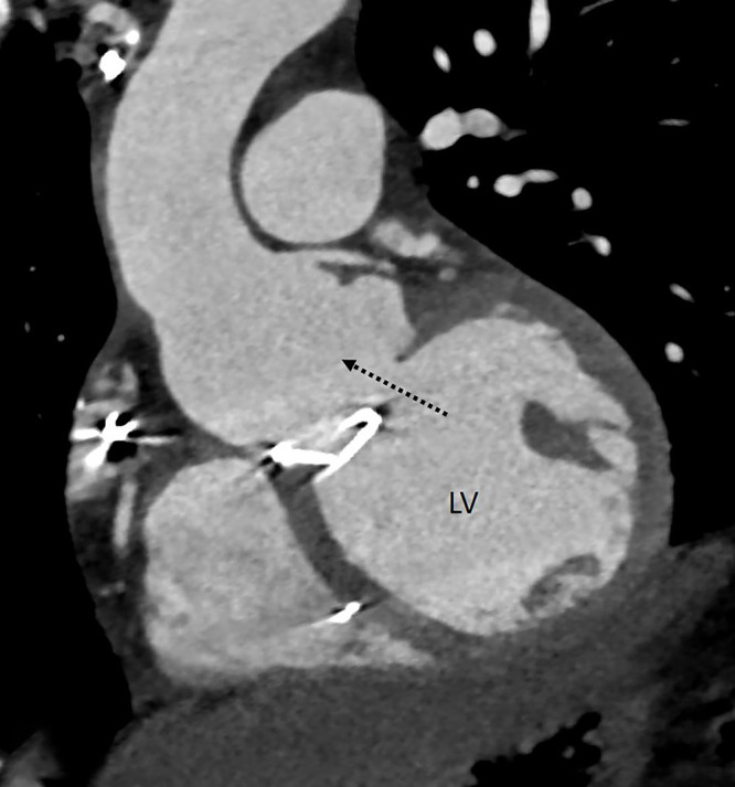 Dehiscence. Oblique coronal CT angiography image shows a gap between the annulus and mechanical prosthetic aortic valve (dashed black arrow) with communication between the aortic root and left ventricular outflow. LV = left ventricle.