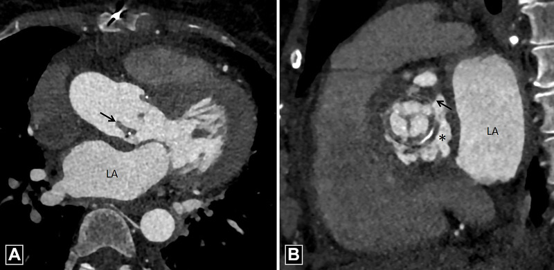 Vegetation. (A) Three-chamber and (B) short-axis CT angiography images in a patient with infective endocarditis reveal low-attenuation soft tissue (black arrow) adherent to bioprosthetic aortic valve, which is suggestive of vegetation with adjacent pseudoaneurysm (asterisk in B). LA = left atrium.