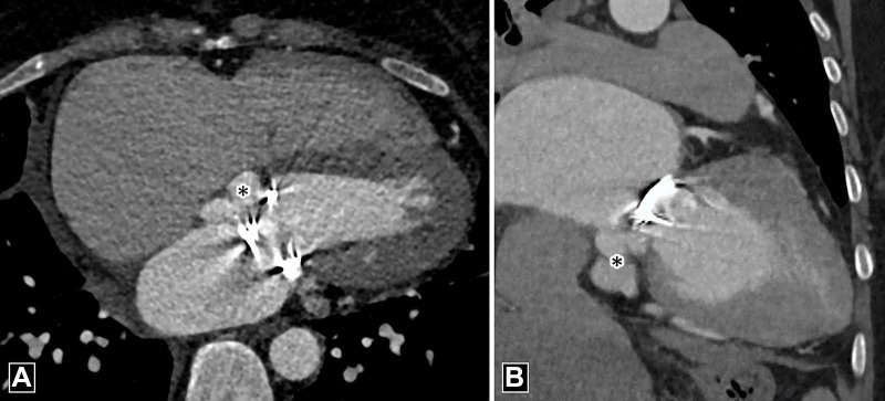 Pseudoaneurysm. (A) Four-chamber and (B) oblique coronal CT angiography images depict contrast material–filled saccular outpouching (black asterisk) adjacent to the prosthetic mitral valve.