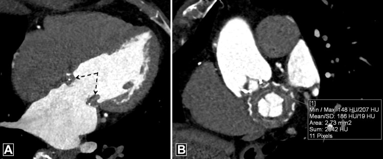 Pannus. (A) Four-chamber and (B) oblique coronal CT images demonstrate circumferential soft tissue (dotted black arrows in A) in a bioprosthetic mitral valve with CT attenuation of 186 HU. Max = maximum, Min = minimum, SD = standard deviation.