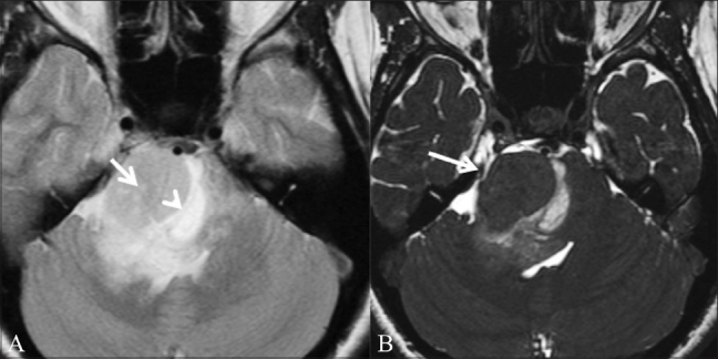 Figure 11 (A,B)