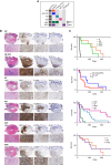 Figure 4. A, Mutation combinations represented in H3K27M models and the acronyms used to refer to them. B, IHC detection of hematoxylin and eosin (H&E), GFP, K27M, and Ki-67 in coronal hindbrain sections from tumor-bearing, symptomatic mice. Embryos were electroporated with vectors encoding (i) H3.3K27M, p53LOF (KP); (ii) H3.1K27M, p53LOF (H3.1KP); (iii) H3.3K27M, FGFR1N457K (KF); (iv) H3.3K27M, NF1LOF (KN); (v) H3.3K27M, p53LOF, FGFR1N457K (KPF); and (vi) H3.3K27M, p53LOF, CCND2WT (KPC). Tumor cells are GFP+. Higher magnification panels below each low-magnification panel are of the tumor bulk in the brainstem, i.e., pons and medulla, which are directly below the cerebellum and fourth ventricle. Scale bars, 2 mm in the low-magnification panels and 200 μm in the high-magnification panels. C, Kaplan–Meier survival curves of IUE, tumor-bearing mice carrying different combinations of mutations. KP (n = 6), H3.1KP (n = 6), KF (n = 10), KN (n = 7), KPF (n = 16), and KPC (n = 9). Statistical comparisons using the log-rank Mantel–Cox tests are described in Supplementary Table S2.