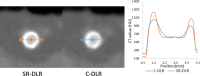 Edge of stent was sharper on coronary CT angiogram using
super-resolution deep learning reconstruction (SR-DLR) than on that using
conventional DLR (C-DLR). Profile curve demonstrates that SR-DLR reduced the
thickness of full width at half maximum of stent.