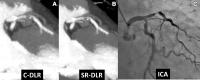 Images in an 81-year-old woman with chest pain on exertion. Severe
stenosis was observed in the left anterior descending artery on an 8-mm
maximum intensity projection image of coronary CT angiography (CCTA).
Compared with CCTA using conventional deep learning reconstruction (C-DLR)
(A), the stringlike continuity of coronary artery was more clearly observed
on CCTA using super-resolution DLR (SR-DLR) (B). (C) Invasive coronary
angiogram (ICA) demonstrates severe stenosis in the left anterior descending
artery.