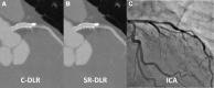 Images in a 66-year-old man after percutaneous coronary intervention
of the left anterior descending artery. (A, B) On coronary CT angiogram,
edge of stent and calcified and noncalcified plaque all appear sharper using
super-resolution deep learning reconstruction (SR-DLR) (B) than using
conventional (C-DLR) (A). (C) Invasive coronary angiogram (ICA) demonstrates
mild stenosis in the left anterior descending artery.