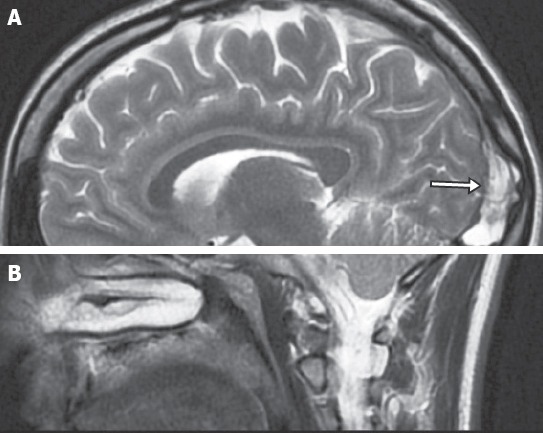 Giant arachnoid granulation mimicking dural sinus thrombosis - PMC