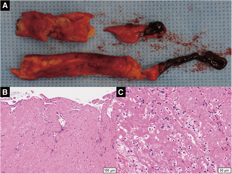 Fig. 2 Extracted abdominal aortic thrombus. (A) Macroscopic image. (B, C) Histological images (hematoxylin–eosin stain). (B) The high-power view (×100) shows an organized thrombus. (C) The high-power view (×200) shows inflammatory cell infiltration in the thrombus.