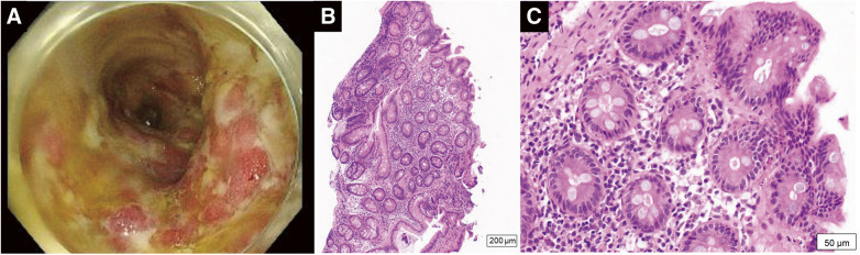 Fig. 3 Diagnostic evaluation of the patient’s ulcerative colitis. (A) Endoscopic imaging showed erosions, ulcers, and spontaneous bleeding in the entire colon. (B) Low-power view (×40) and (C) high-power view (×200) showed inflammatory cell infiltration throughout the mucosa.